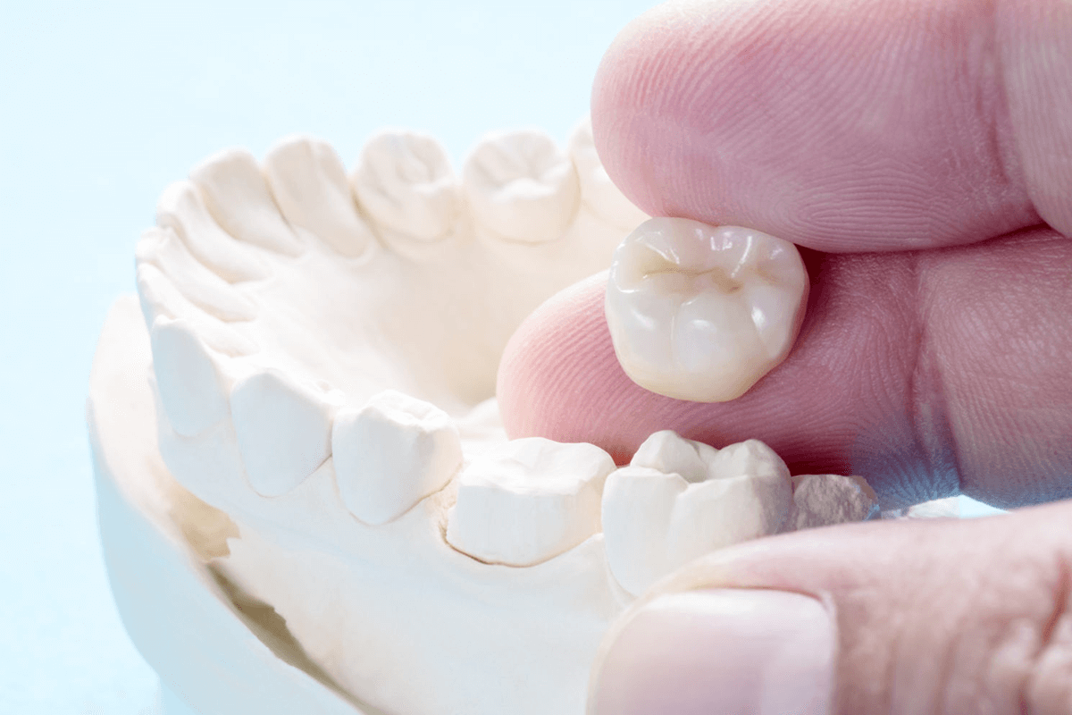 DENTAL CROWNS