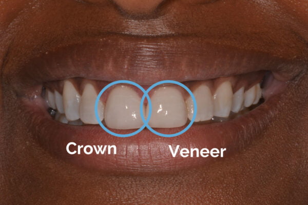 Cosmetic Orthodontic