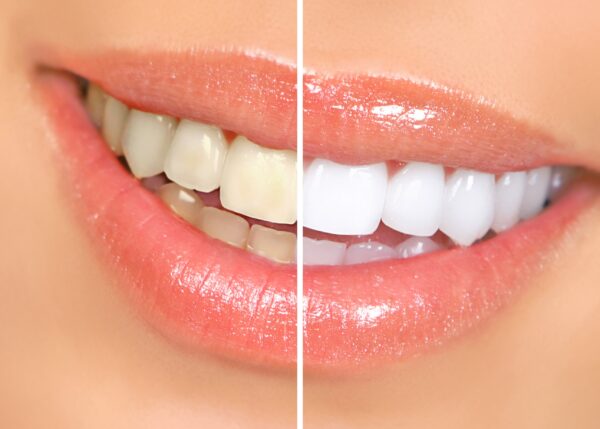 Cosmetic Orthodontic