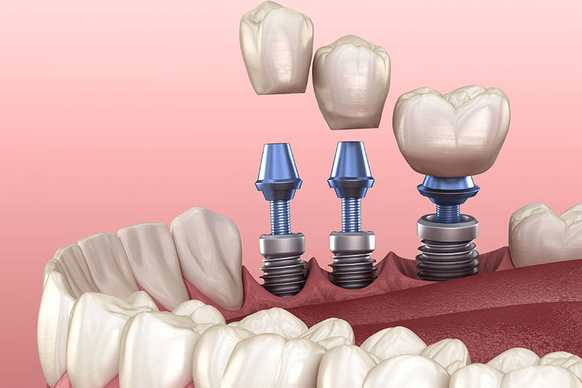 Dental Implants