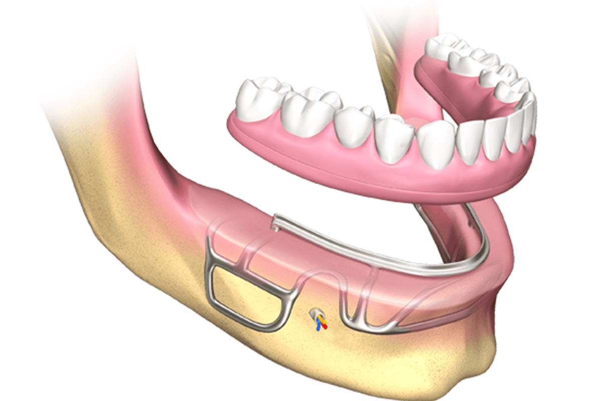 Dental Implants