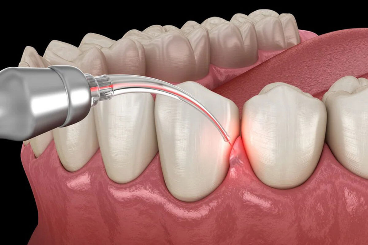 Gingivectomy / Gum Lift