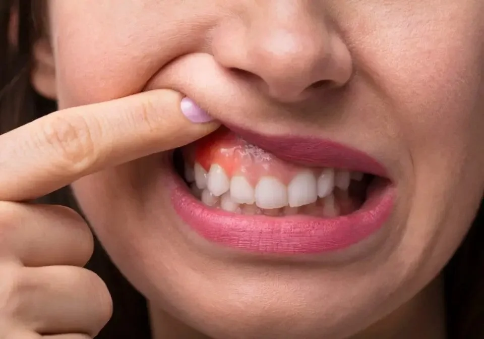 Black Gums: Causes, Symtoms, Treatments & Prevention